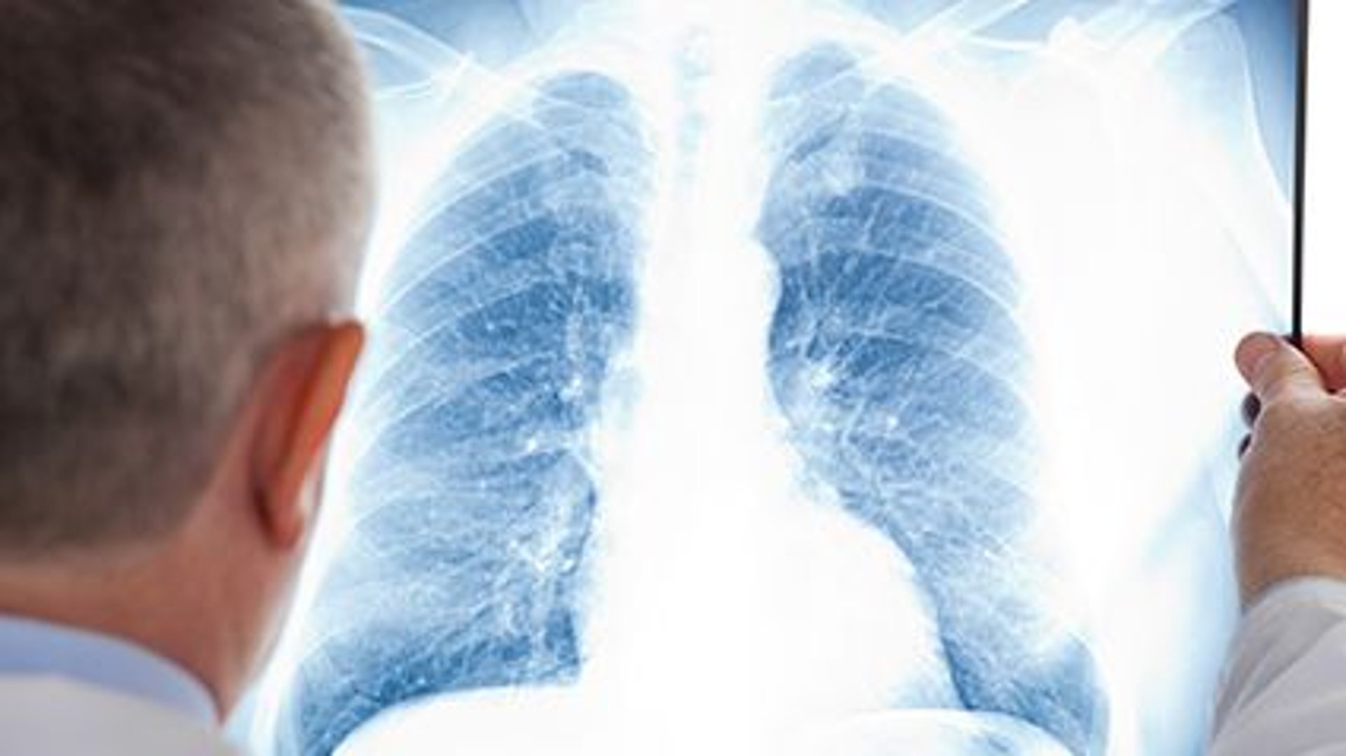 Pandemic Closures, Fears Keep Patients From Lung Cancer Screening thumbnail
