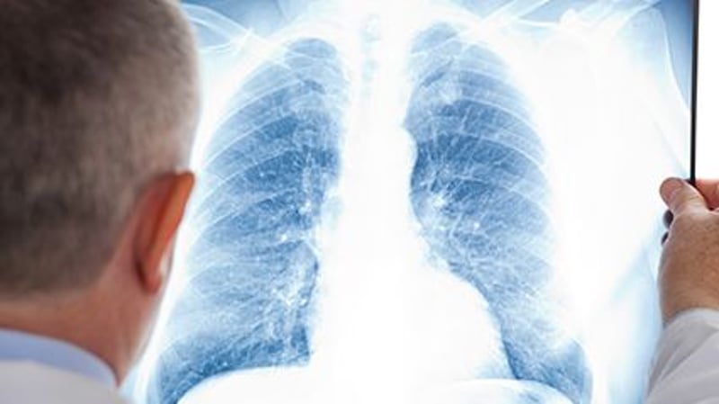 'Liquid Biopsy' Could Help Guide Lung Cancer Treatment
