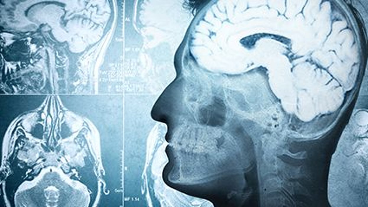Multifocal Microvascular Injury ID'd in Brain in COVID-19