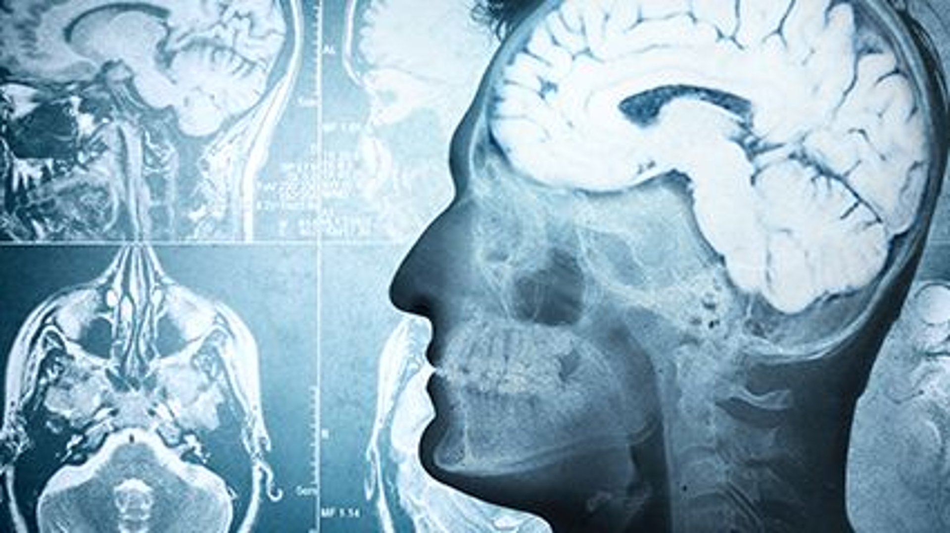 Brain May Age Faster After Spinal Cord Injury thumbnail