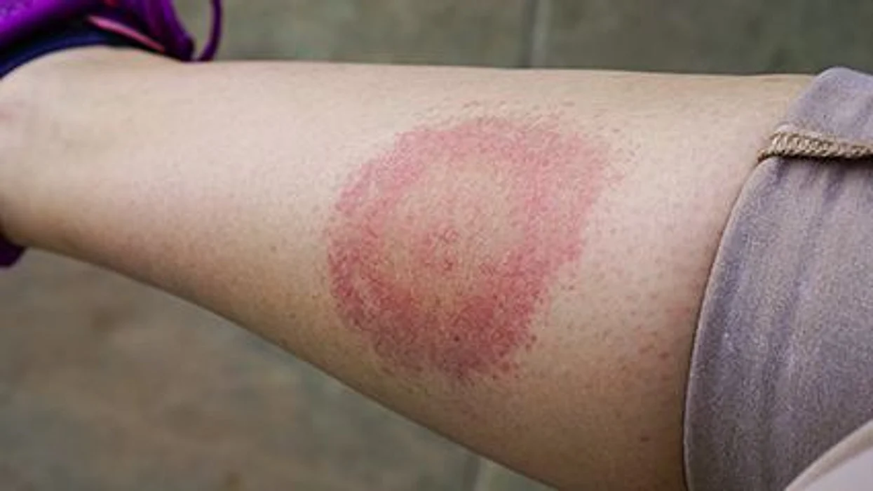 Lyme disease prevention