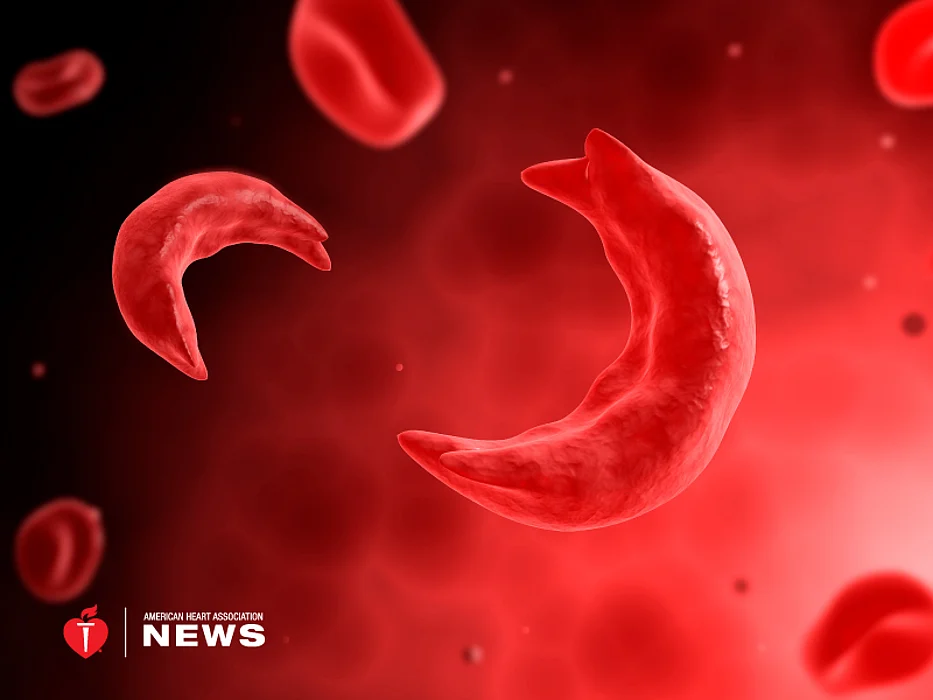 sickle cell anemia