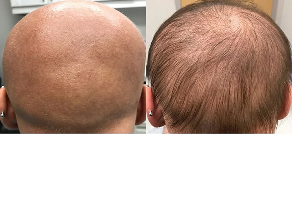 An Eczema Drug Helped Regrow a Girl's Hair -- Could It Help Others? - Consumer Health News | HealthDay An Eczema Drug Helped Regrow a Girl's Hair -- Could It Help Others? - Consumer Health News | HealthDay