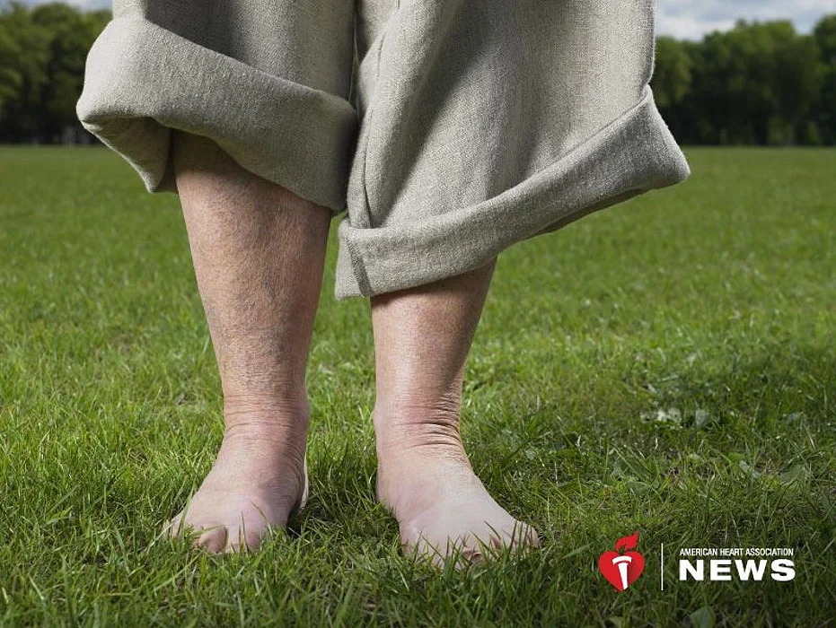 Early Detection of Severe Circulation Problem Can Prevent Amputations