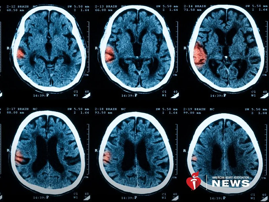 Ozone polution may be linked to a type of bleeding stroke
