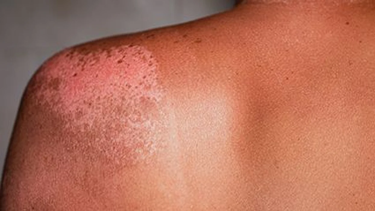 Most Dermatology Patients Like 'Telehealth' Visits: Survey