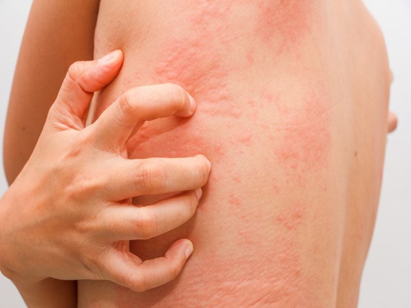 Stress Rash: What Is It and How to Treat It
