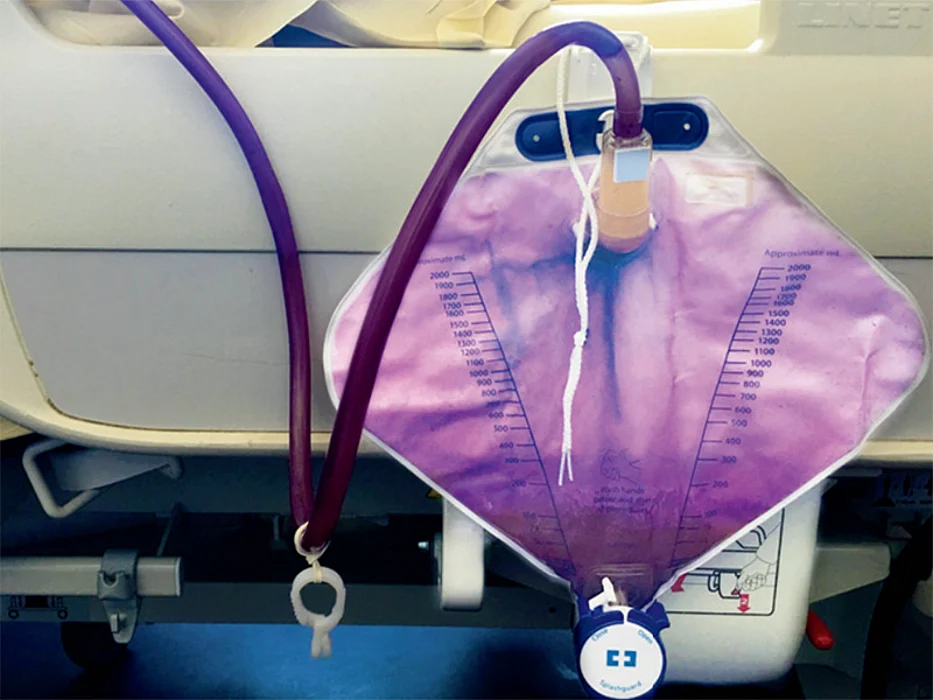 Purple urine