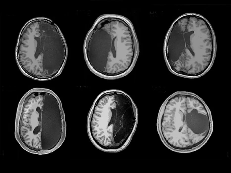 brain morph