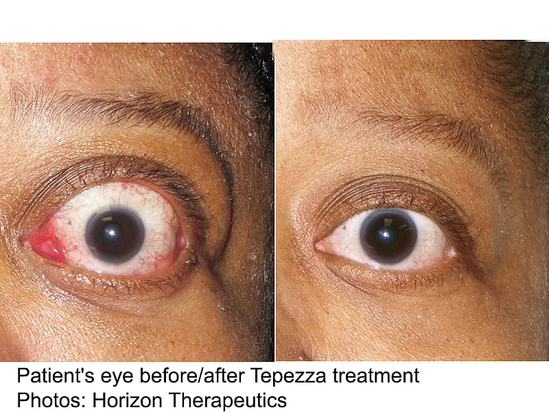 New Drug Could Help Stop Blindness From Thyroid Eye Disease Consumer