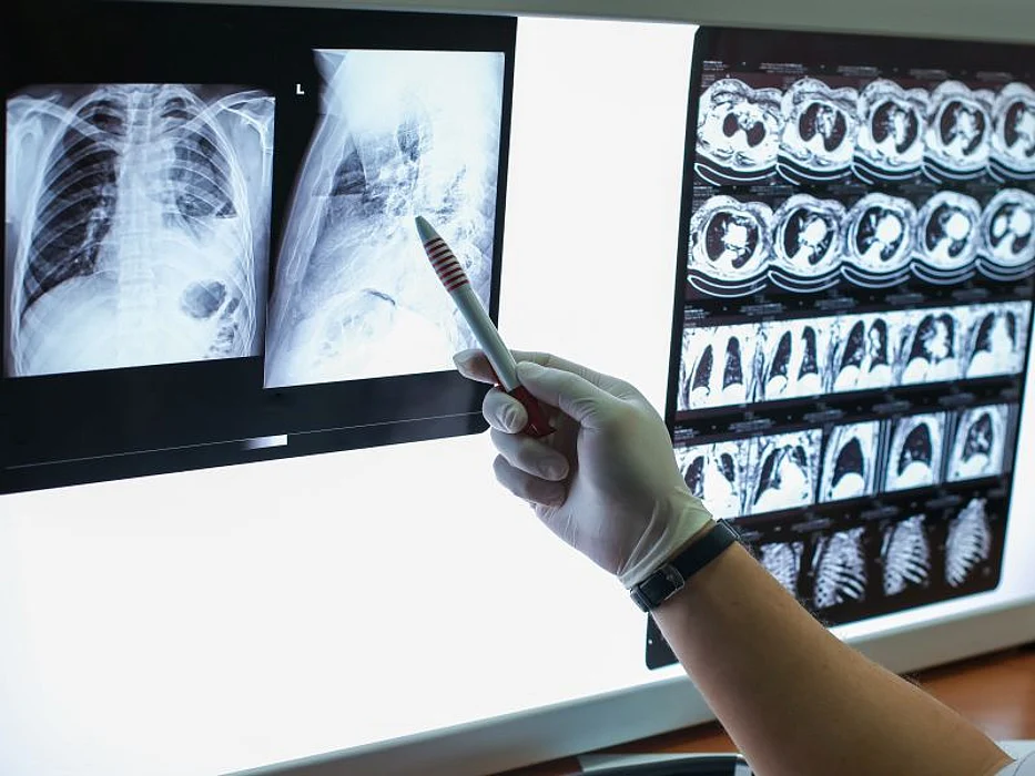 x-ray showing COPD