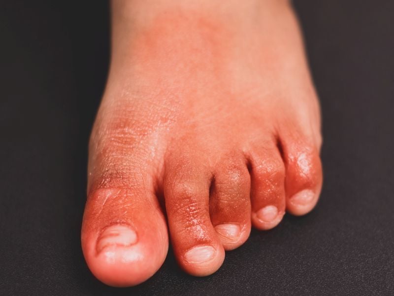 For some survivors, “COVID Toes”, the rash can last for months-consumer health news