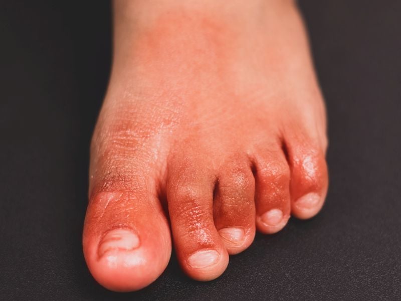 For Some Survivors, 'COVID Toes,' Rashes Can Linger for Months