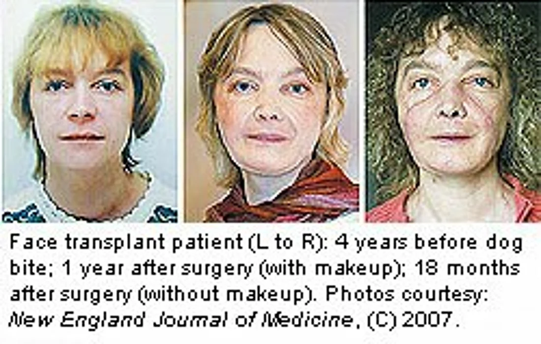 Partial Face Transplant Patient Doing Well