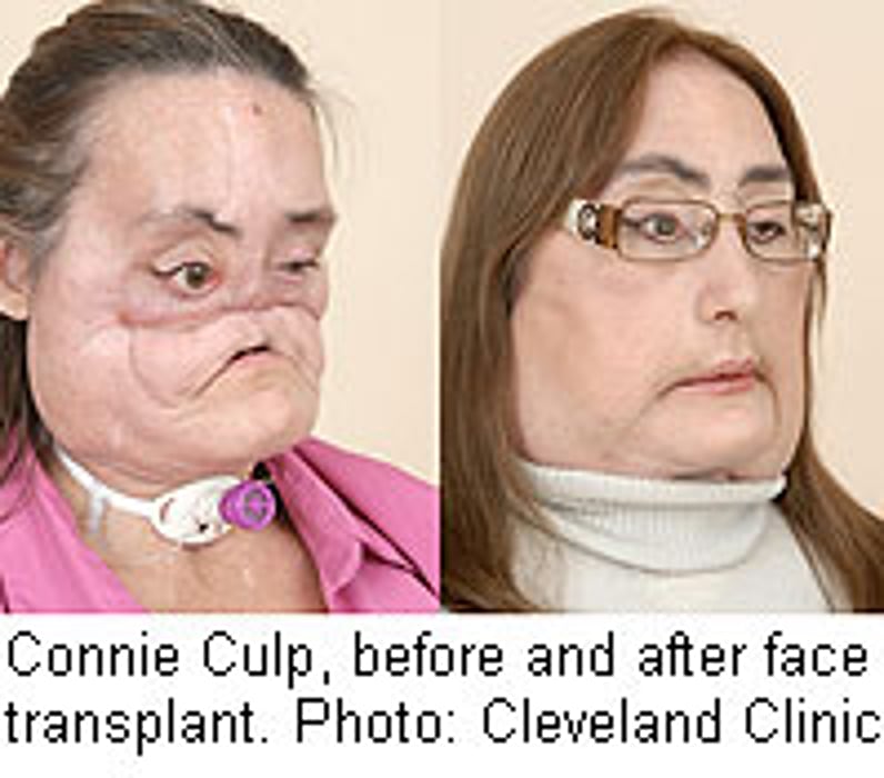 U.S. Face Transplant Patient Is Reportedly Doing Fine