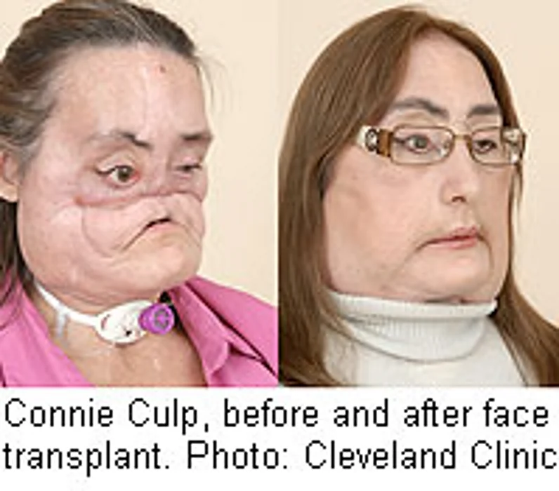 Face Transplant Patient Can Smell, Taste, Breathe Normally