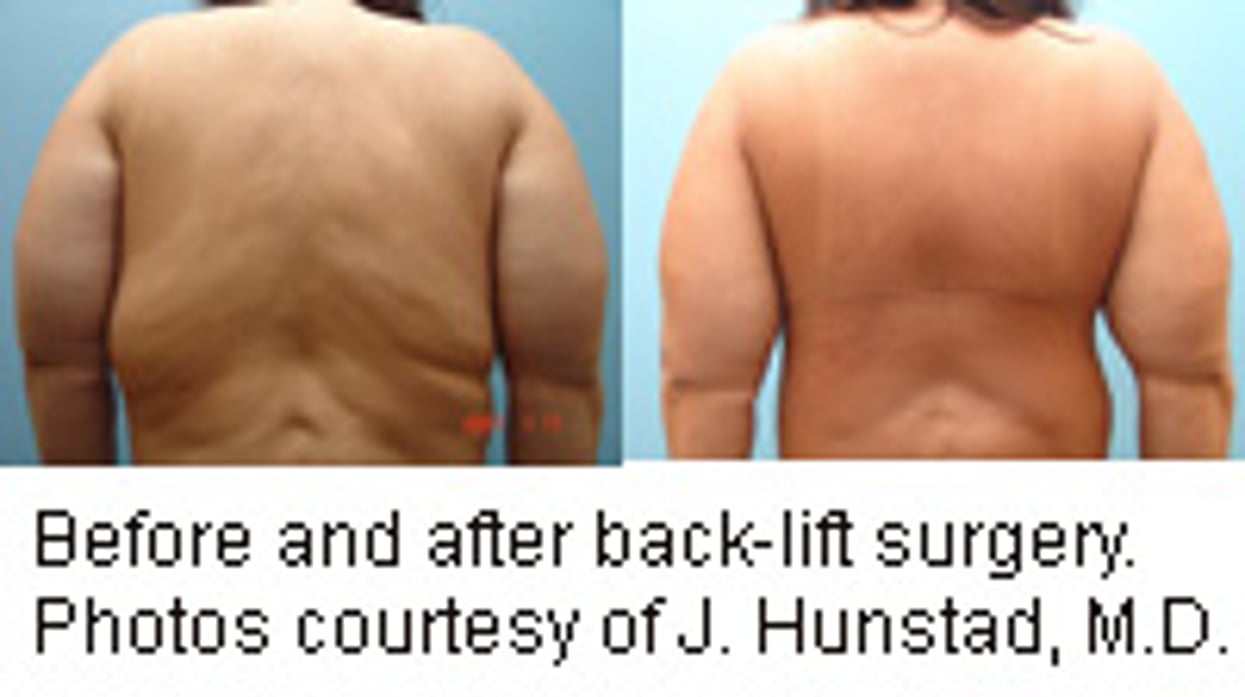 Bye, Bye Back Fat?