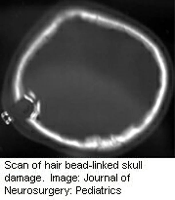 Hair Beads Spurring Head Trauma in Kids