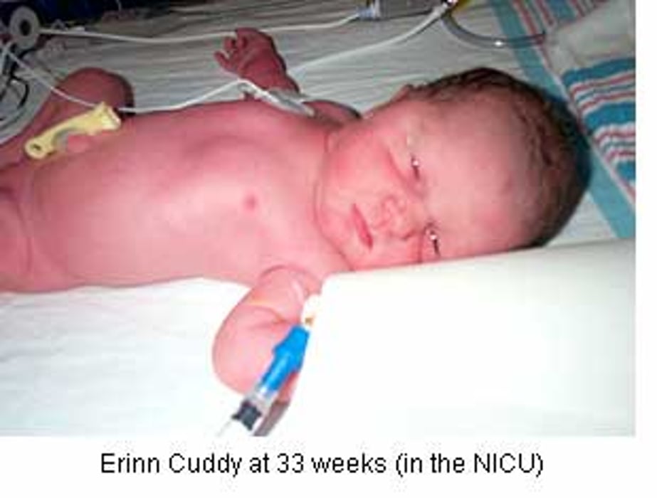Premature Births on the Rise