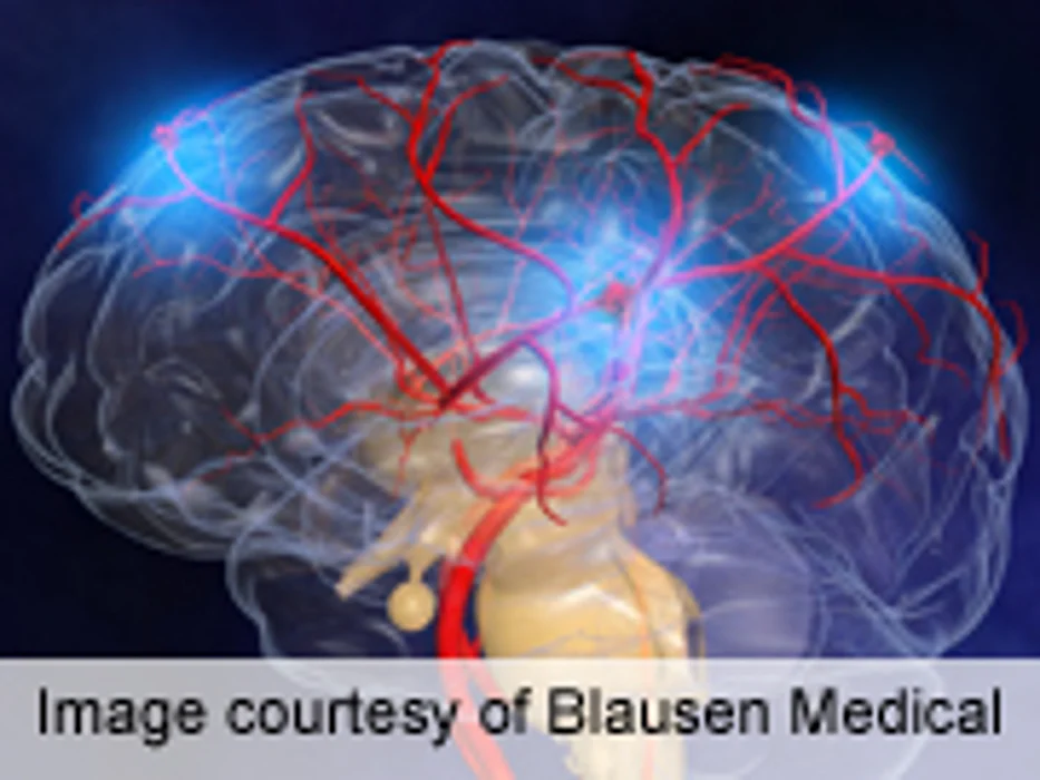 DRAGON Score Helps Predict Functional Outcomes in Stroke