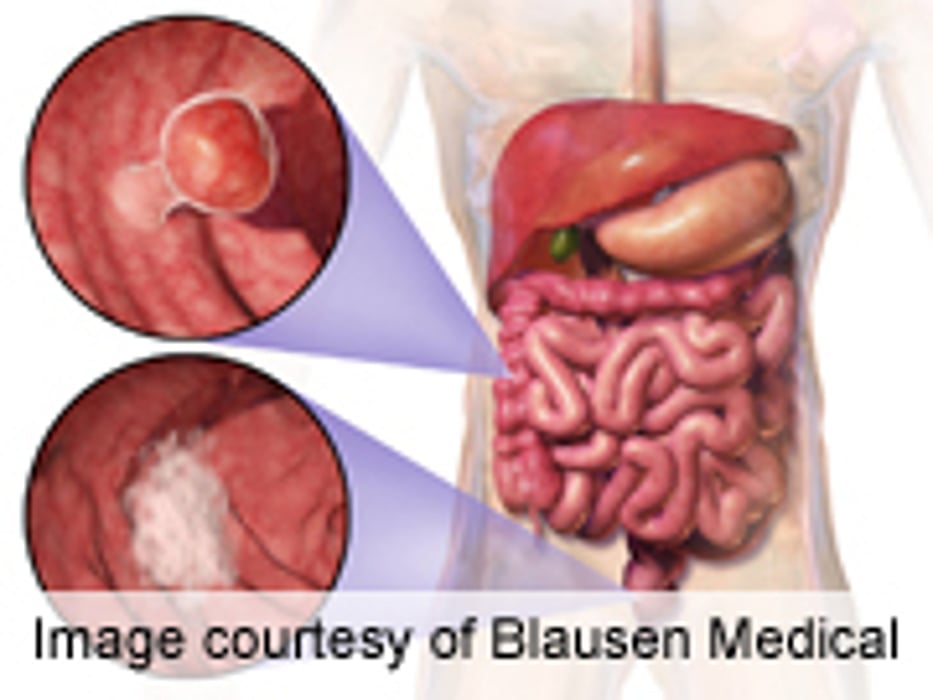 Similar Genetic Alterations in Most Colon, Rectal Cancers