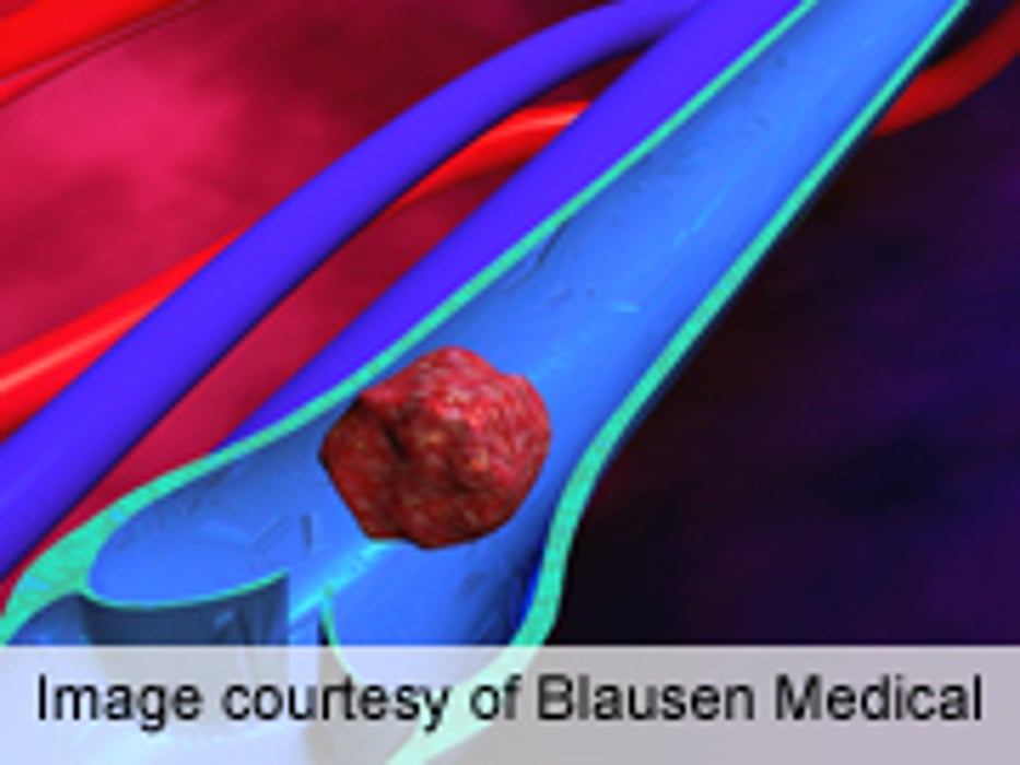 Longer Sugeries May Increase Risk of DVT, PE