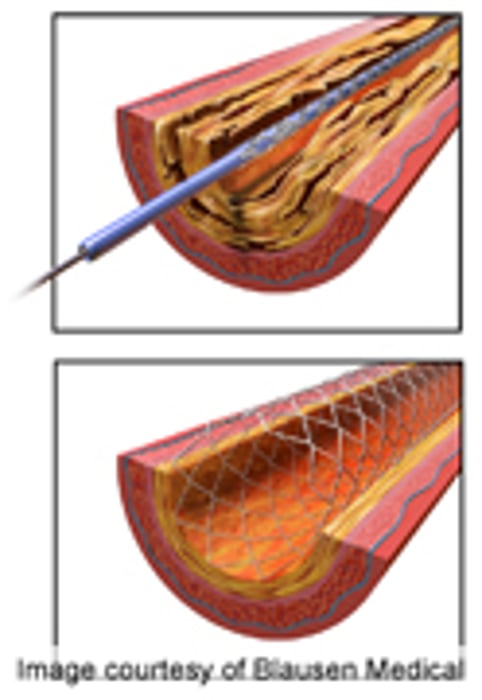 AHA: Incidence of Repeat Blockage of Carotid Artery Low