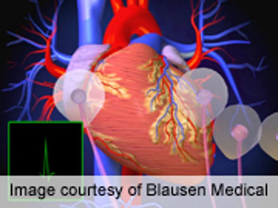 AHA: Rivaroxaban Tied to Lower Brain Bleed Risk in A-Fib