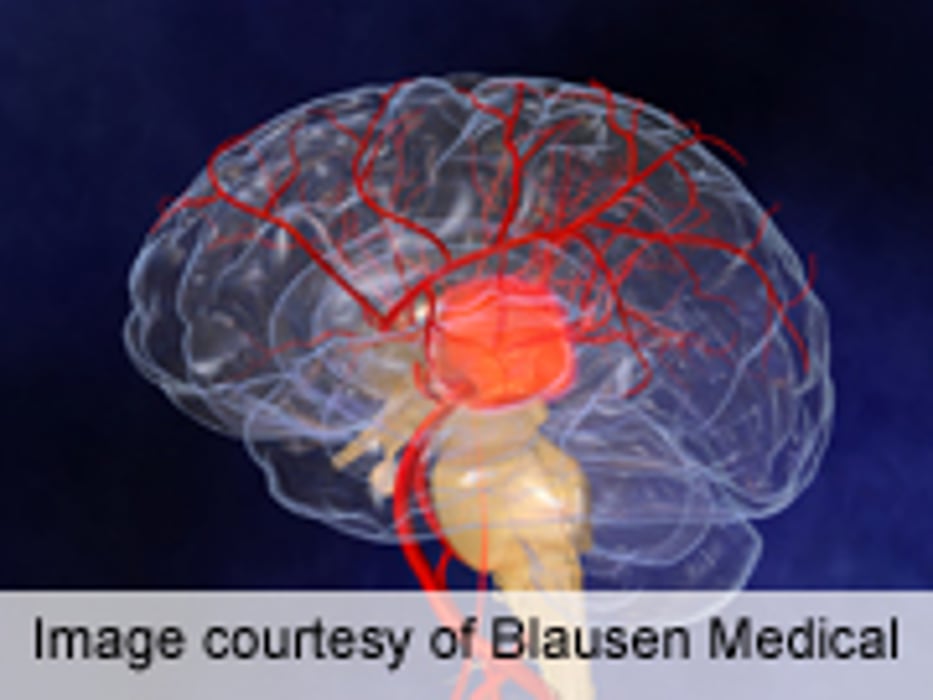 New Anti-Clotting Drug May Cut Brain Bleeding Risk: Study