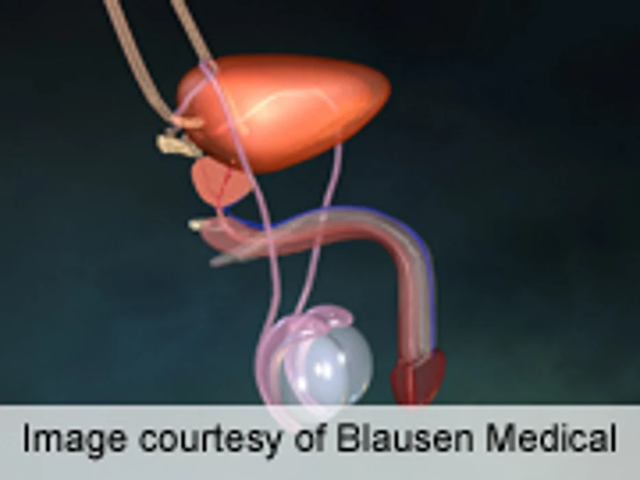 Study Casts Doubt on Value of Pricey Prostate Cancer Therapy