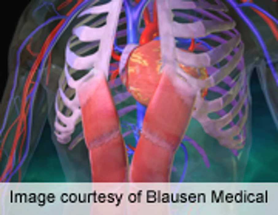 FDA Issues Multiple Sclerosis Drug Alert