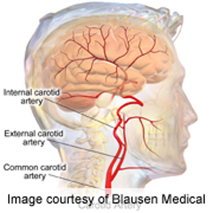Pediatric Kidney Disease Tied to Abnormal Carotid Arteries
