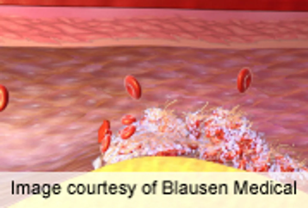 Clot-buster Drug Injection Might Help Some Heart Attack Patients