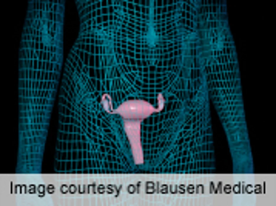 Scientists Uncover Genetic Link for Uterine Fibroids