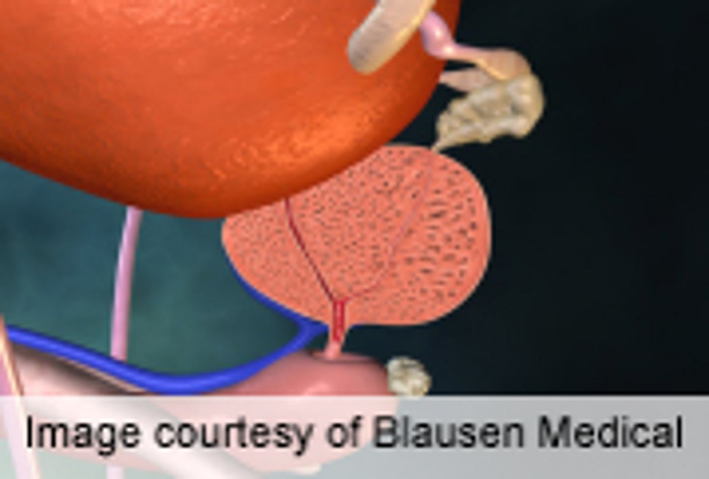 Prostate Size Predicts Gleason Score Upgrading