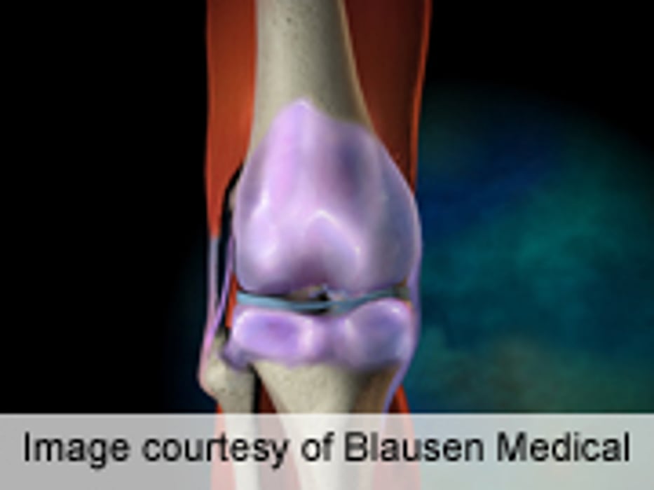 Regional Anesthesia Doesn't Up Falls After Knee Replacement