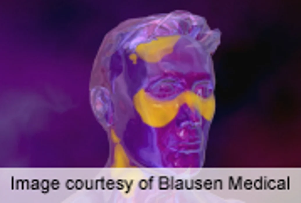 Belimumab Deemed Safe for Long-Term Treatment of Lupus