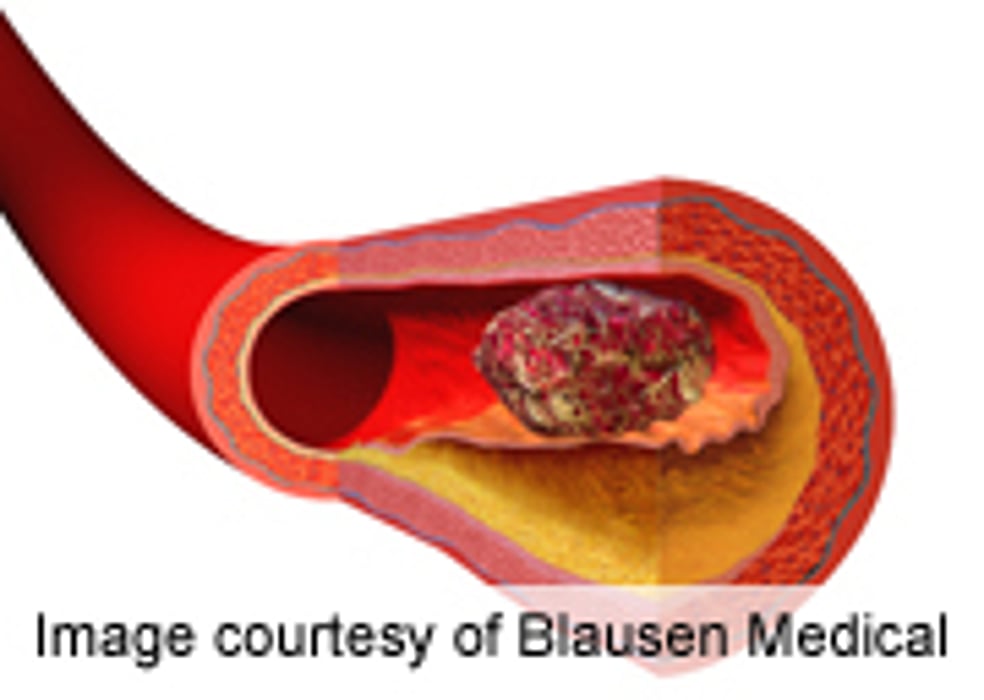 AHA: Edoxaban Noninferior to Warfarin for Stroke Prevention