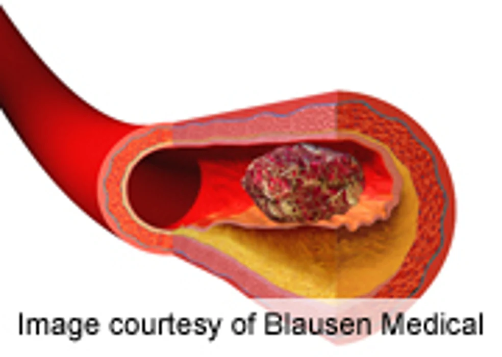 AHA: Concentrates Promising for Reversal of Apixaban