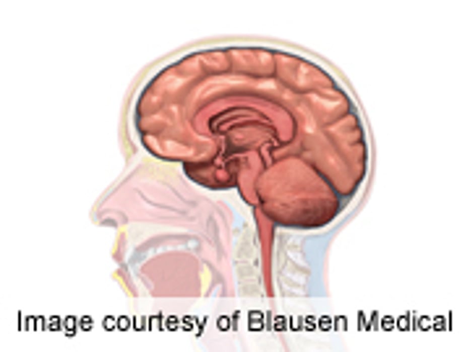 Electrical Brain Stimulation May Strengthen Memory, Study Says