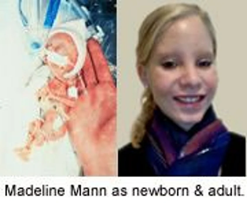 World's Tiniest 'Preemies' Growing Up Healthy: Report