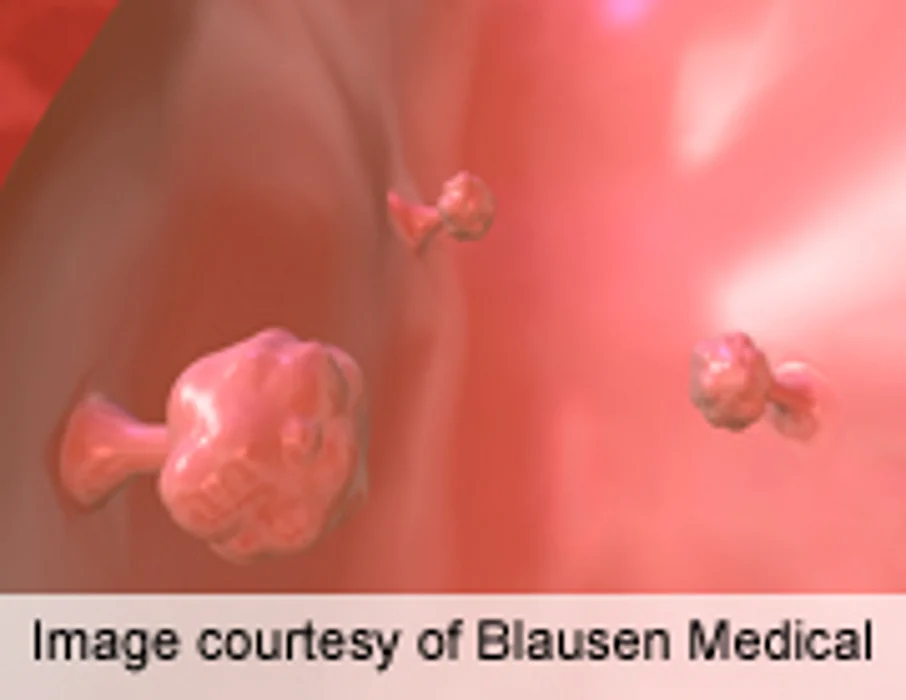 Colorectal Cancer on the Rise for U.S. Adults Under 50