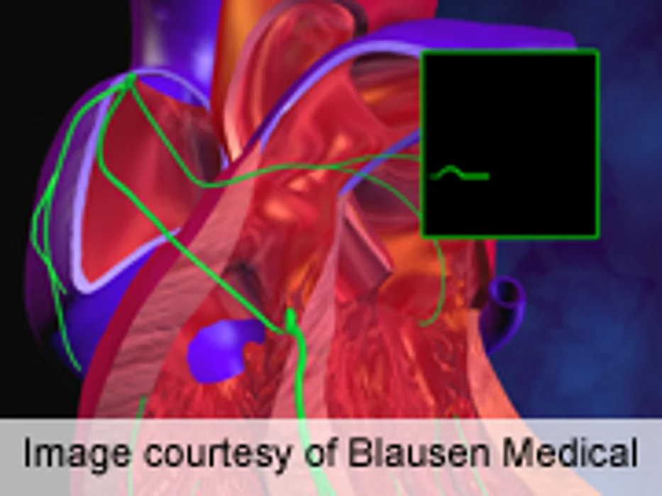 AHA: Atrial Fibrillation Hospitalizations Increasing