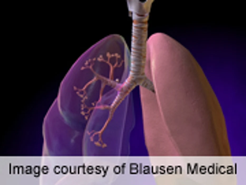 Model More Accurately Predicts Lung Cancer Risk