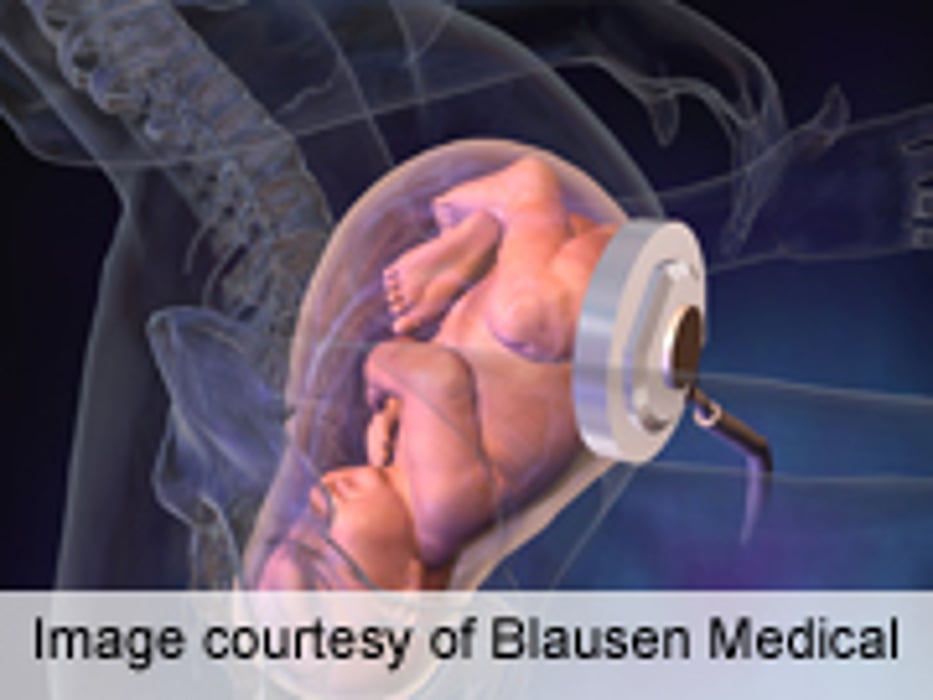 Fever, Epidural Combo Ups Adverse Neonatal Outcomes