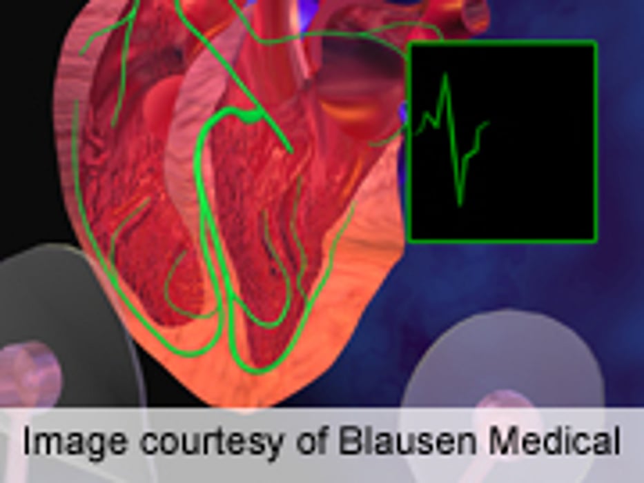 Moderate Drinking Ups A-Fib Risk in Adults at Risk for CVD