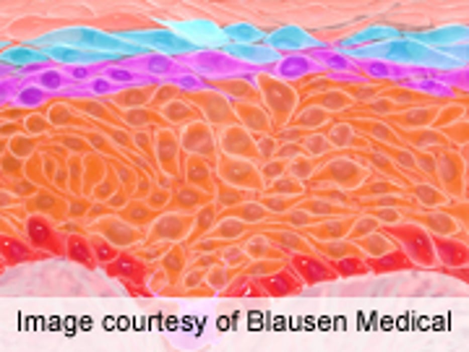 Common Skin Cancer a Chronic Condition, Study Says