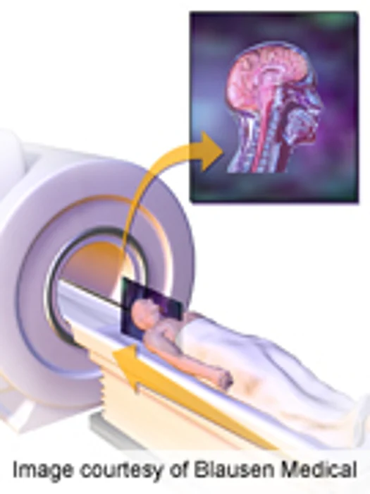 Brain Scans Overused on U.S. Stroke Patients Study Says