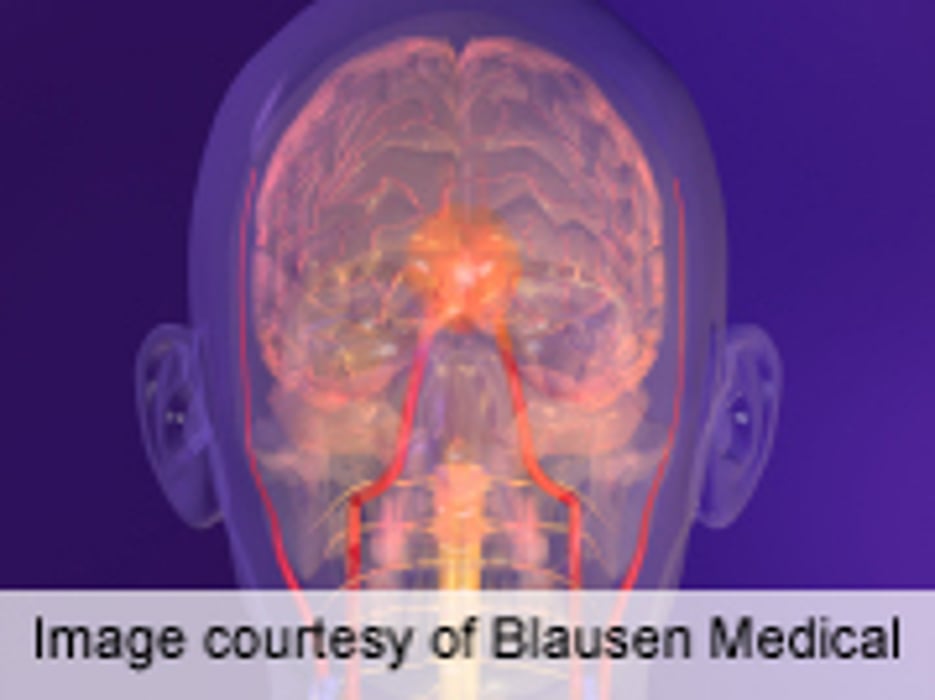 No Difference in Stroke Risk Based on Body Mass Index