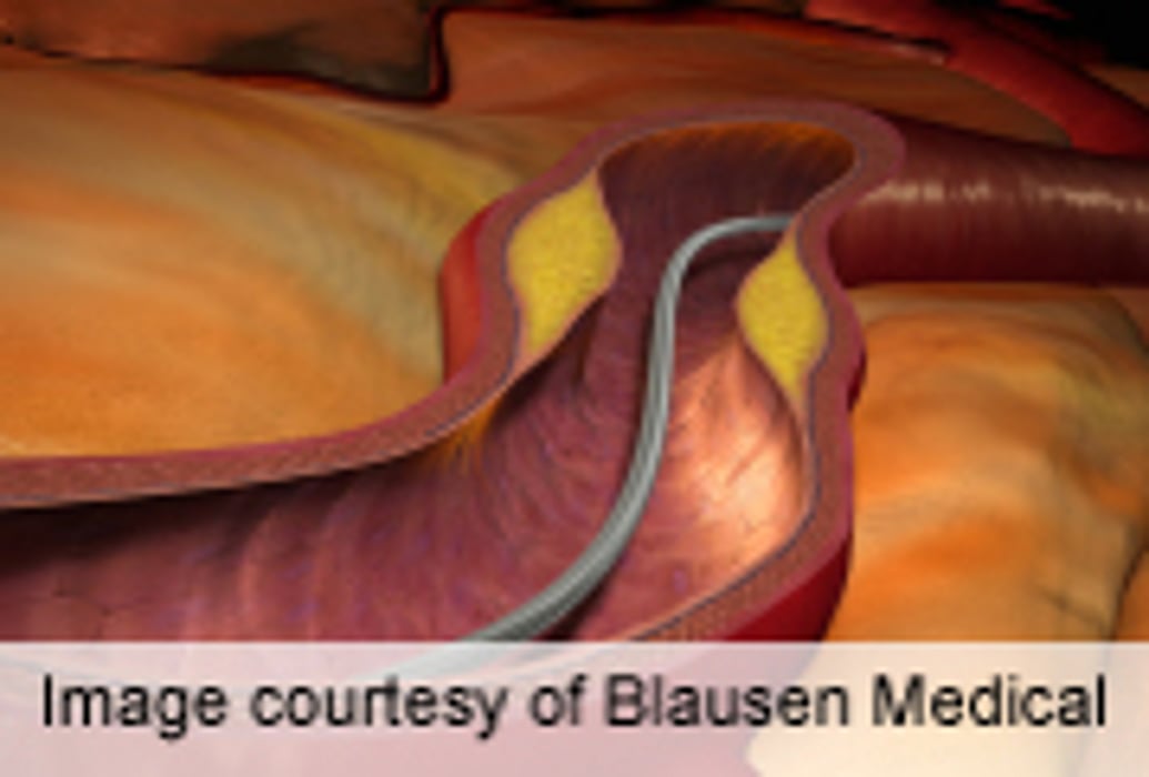Drug-Eluting Stents Reduce Risk of Thrombosis